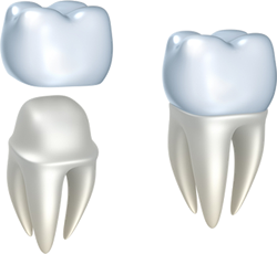 Dental Crowns in Hermon and Bangor, ME
