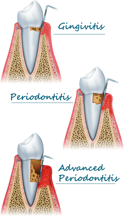 Gum Disease Stages - Gingivitis, Periodontitis, and Advanced Periodontitis