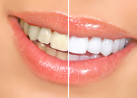 Teeth Whitening in Hermon and Bangor, ME